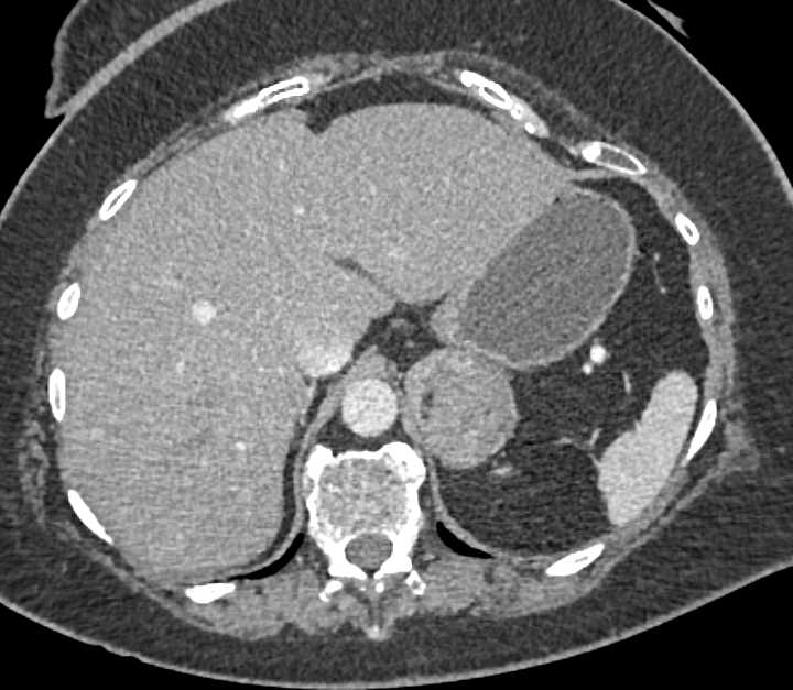 Left Adrenal Myelolipoma - CTisus CT Scan