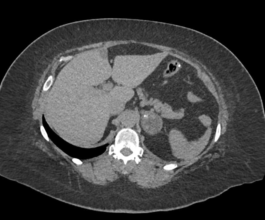 Left Adrenal Myelolipoma - CTisus CT Scan