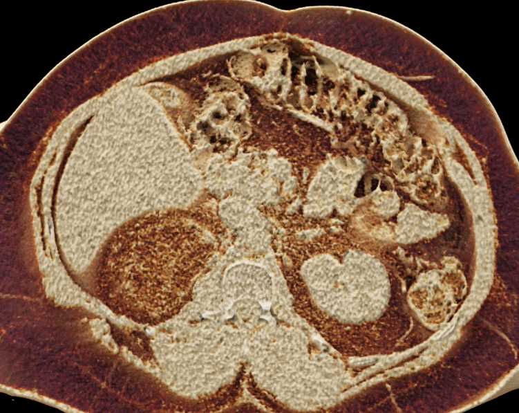 Right Adrenal Myelolipoma - CTisus CT Scan