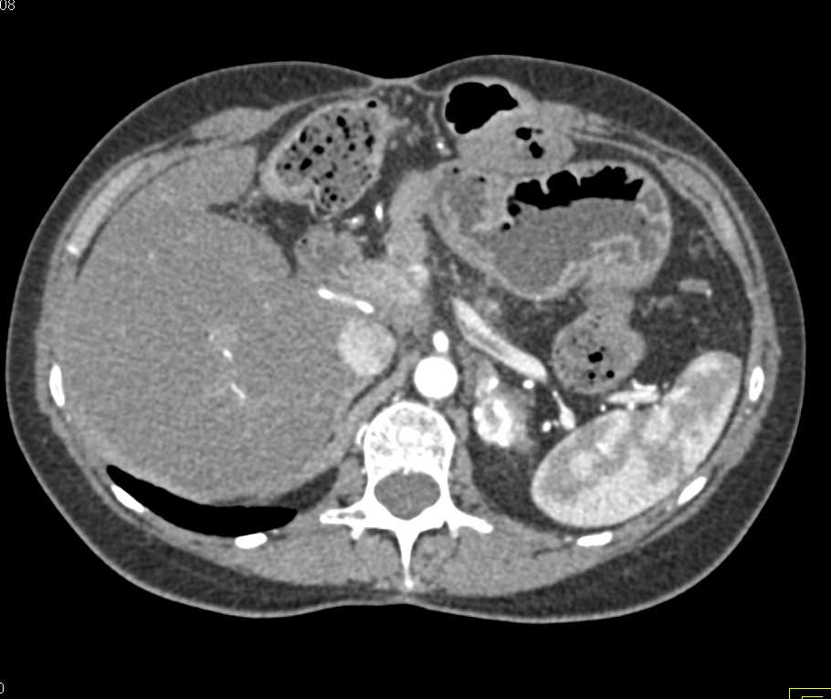 Pheochromocytoma Left Adrenal Gland - CTisus CT Scan