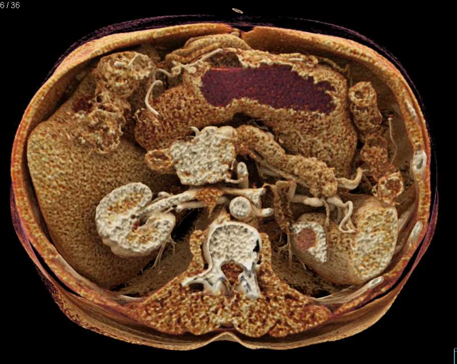 Carcinoma Body of the Pancreas - CTisus CT Scan
