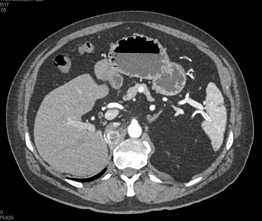 Metastatic Renal Cell Carcinoma to the Right Adrenal - CTisus CT Scan