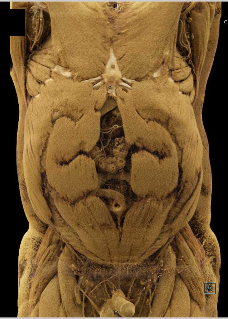 Metastatic Renal Cell Carcinoma to the Adrenal Glands - CTisus CT Scan