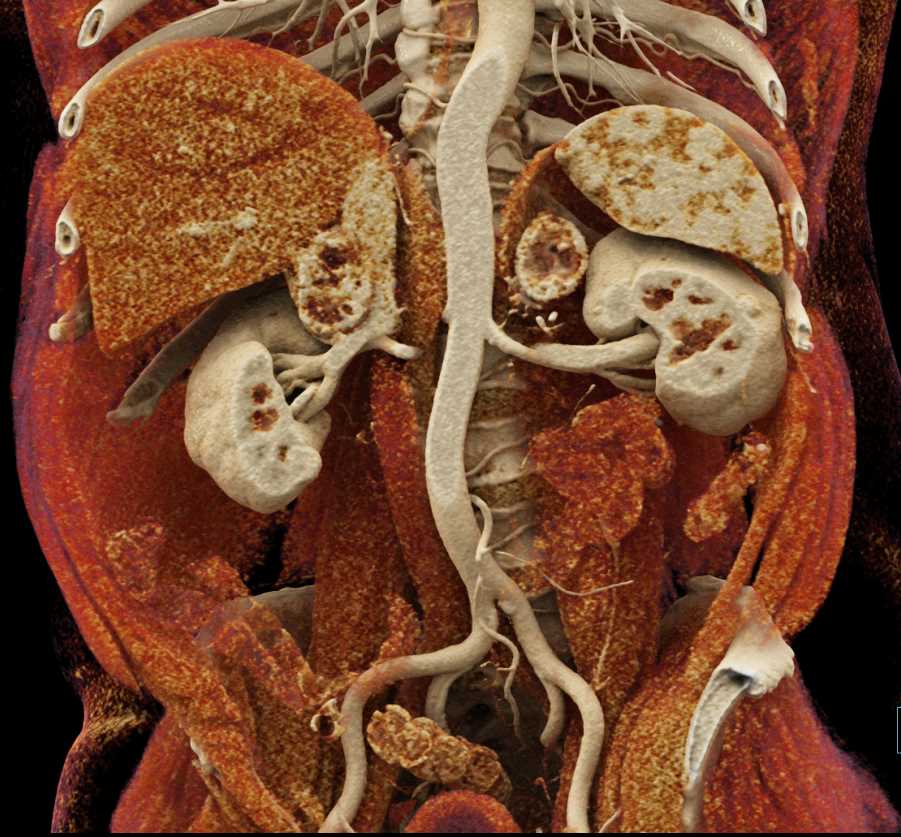 Metastatic Renal Cell Carcinoma to the Adrenal Glands - CTisus CT Scan