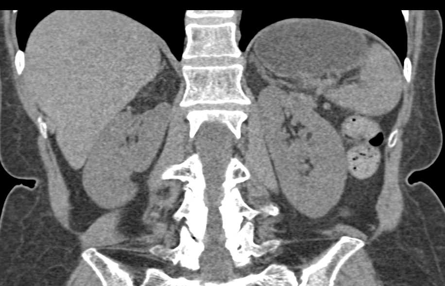 Myelolipoma Right Adrenal Gland - CTisus CT Scan