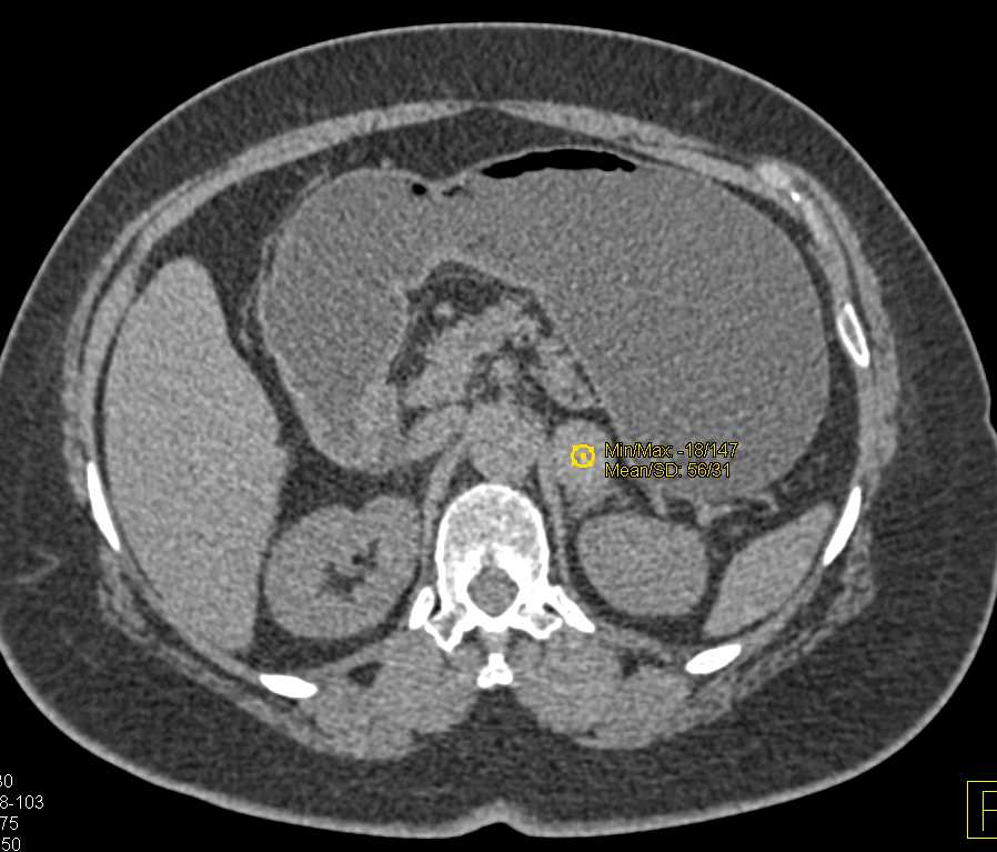 Fat Poor Left Adrenal Adenoma - CTisus CT Scan