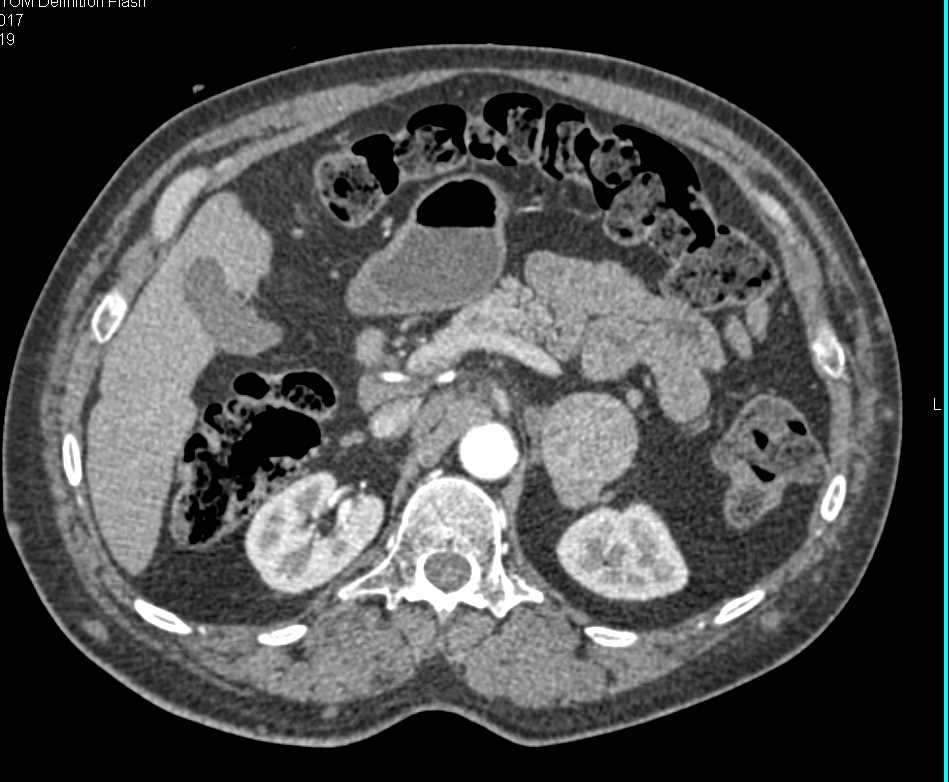 Accessory Spleen Simulates an Adrenal Mass - CTisus CT Scan