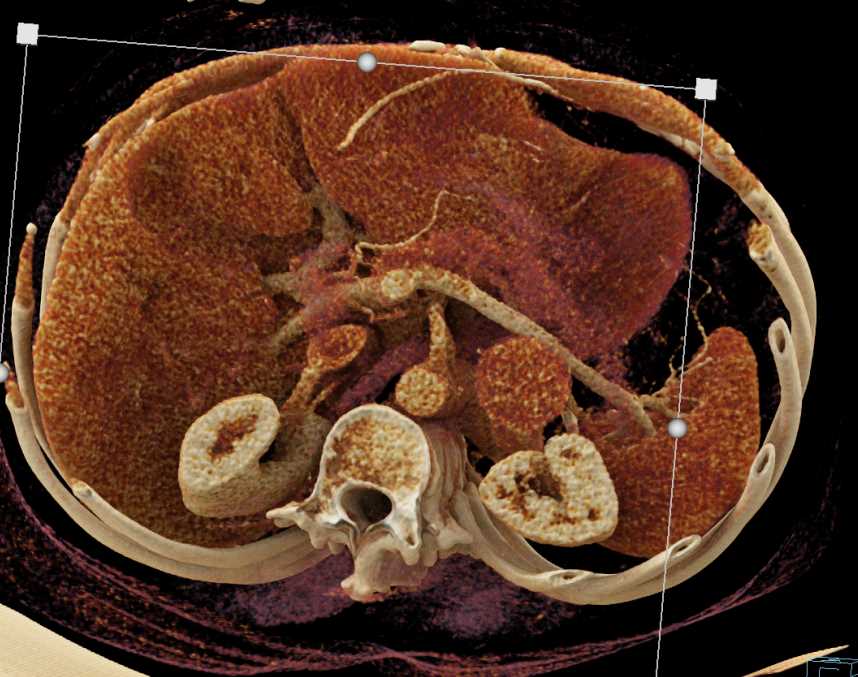 Pheochromocytoma Left Adrenal Gland - CTisus CT Scan