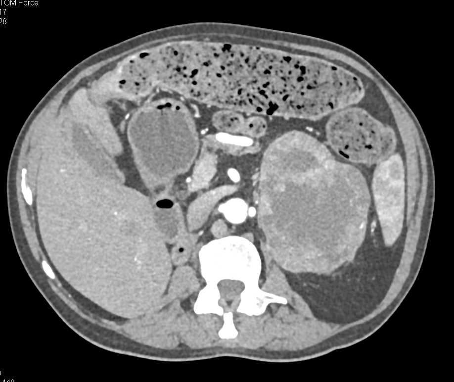 Primary Adrenal Carcinoma - CTisus CT Scan