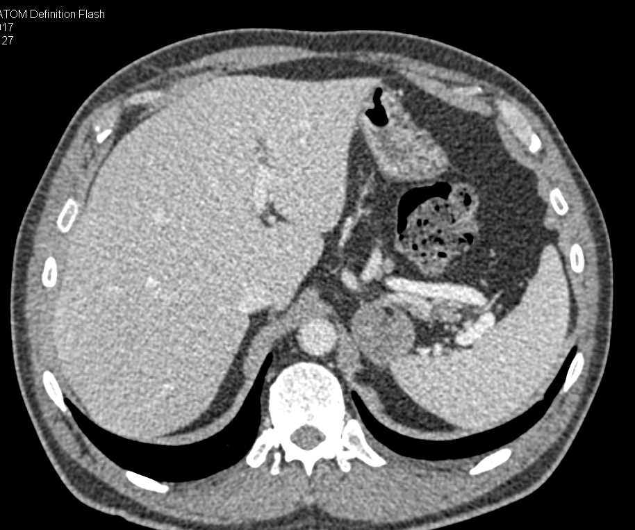 Myelolipoma Left Adrenal Gland - CTisus CT Scan