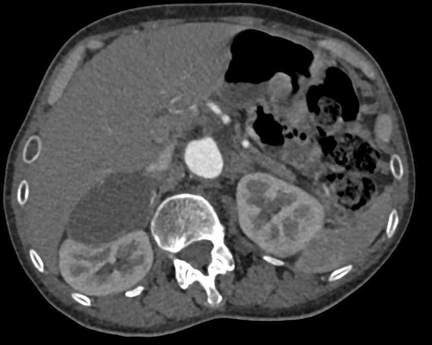Adrenal Cyst - CTisus CT Scan