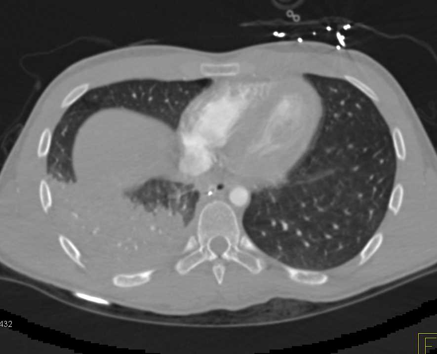 Trauma with Liver, Lung and Adrenal Injury - CTisus CT Scan