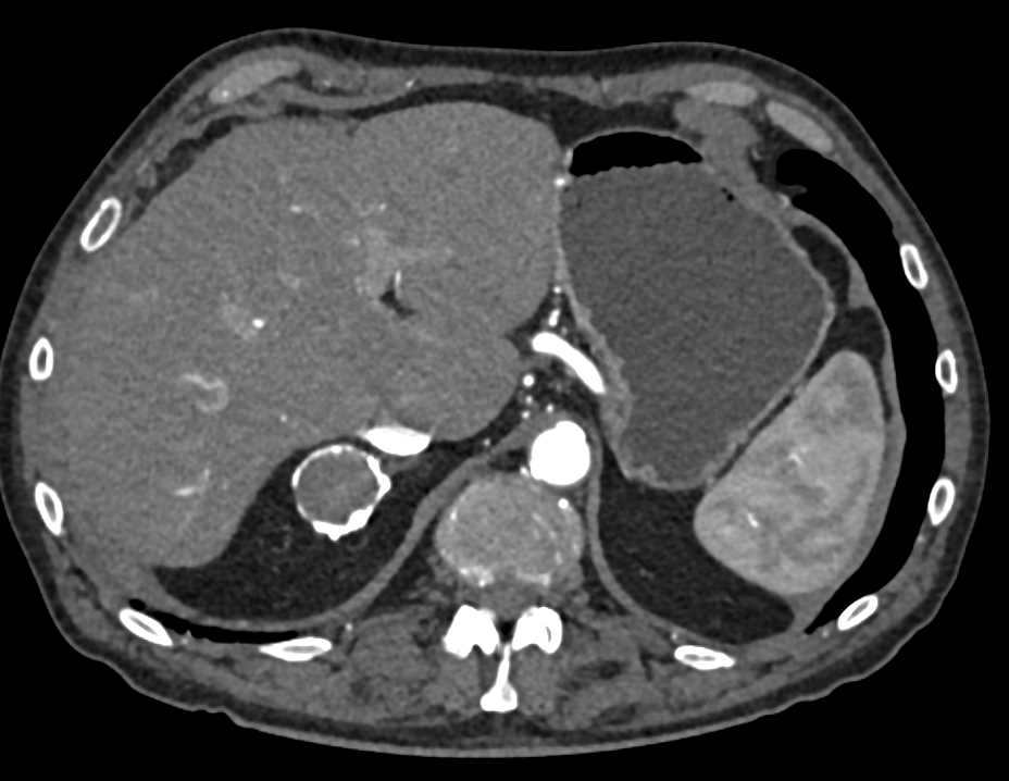 Old Hematoma Right Adrenal Gland - CTisus CT Scan