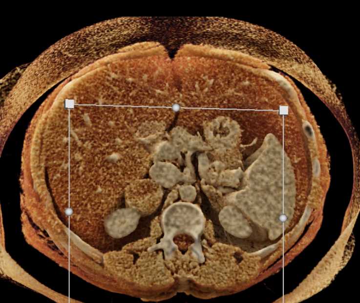 Vascular Adenoma Right Adrenal Gland with Cinematic Rendering - CTisus CT Scan