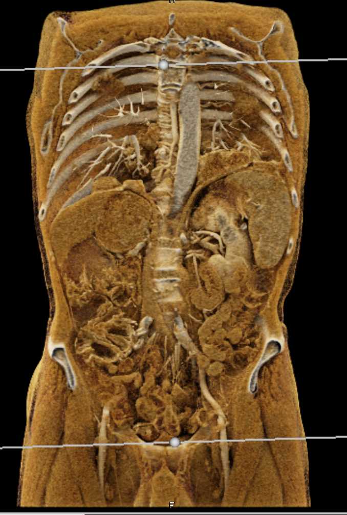 Metastatic Melanoma - CTisus CT Scan