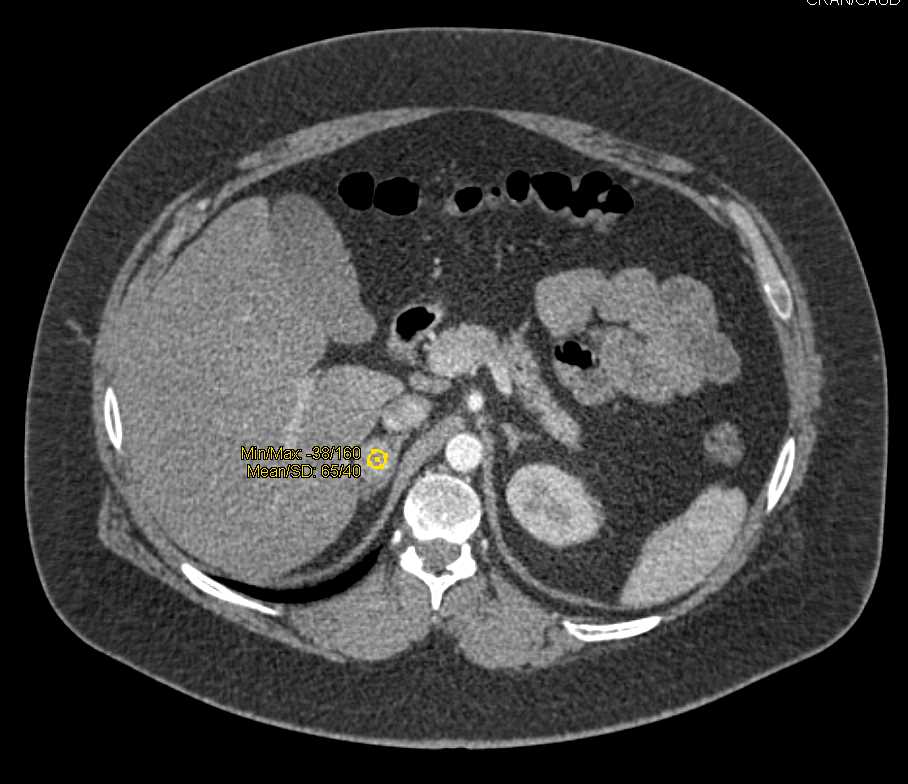 Adrenal Adenoma with Enhancement Like A Pheochromocytoma - CTisus CT Scan