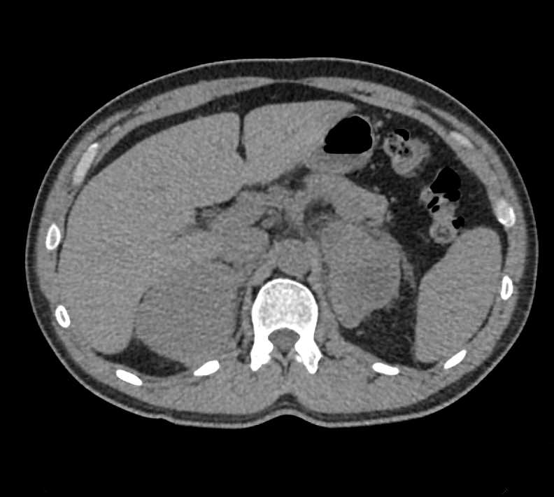 Primary Adrenal Lymphoma - CTisus CT Scan