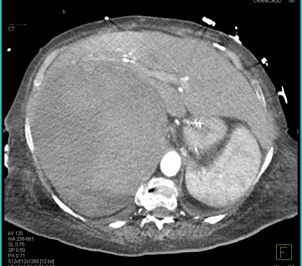 Large Right Adrenal Hematoma - CTisus CT Scan
