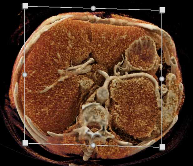 Primary Adrenal Cortical Carcinoma - CTisus CT Scan