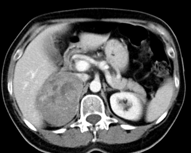 Adrenal Cortical Carcinoma - CTisus CT Scan