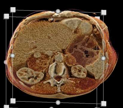 Adrenal Metastases - CTisus CT Scan
