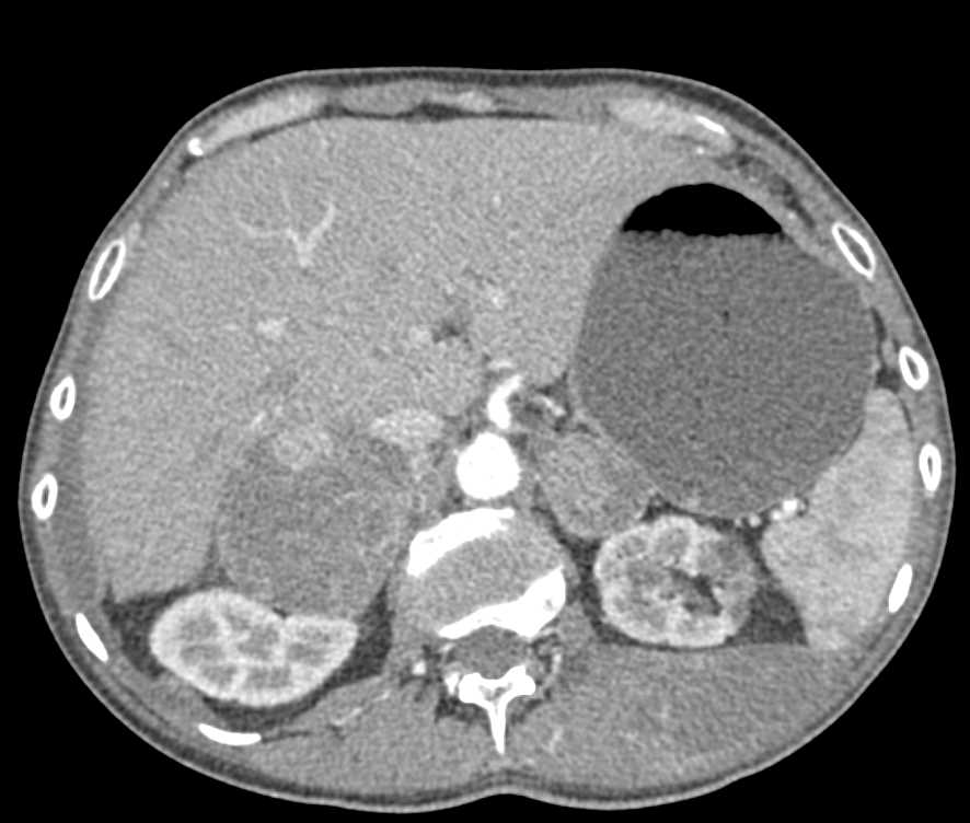 Adrenal Metastases - CTisus CT Scan