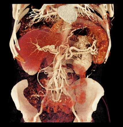 Adrenal Metastases - CTisus CT Scan