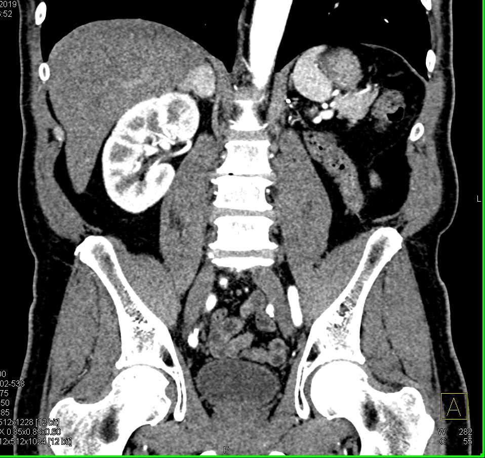 Right Adrenal Pheochromocytoma - CTisus CT Scan