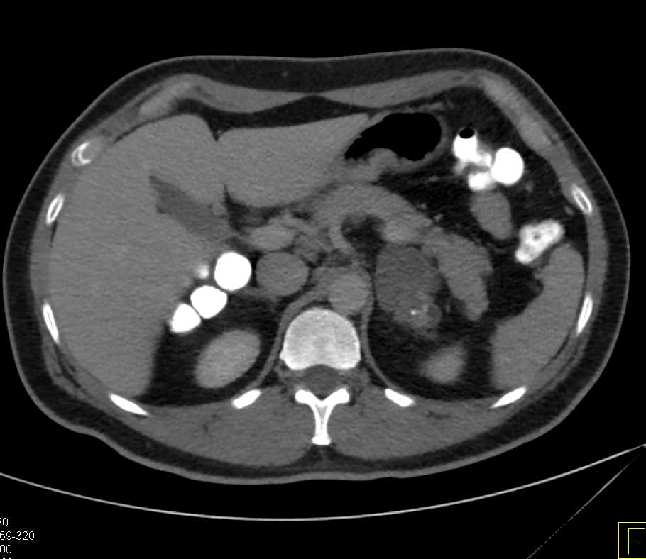 Left Adrenal Lymphangioma - CTisus CT Scan