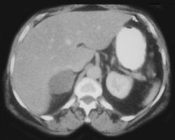 Adrenal Adenoma - CTisus CT Scan