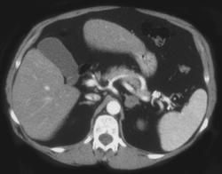 Adrenal Adenoma (lt) - CTisus CT Scan