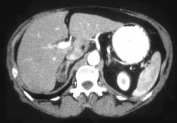 Adrenal Adenoma - CTisus CT Scan