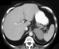 Adrenal Carcinoma - CTisus CT Scan