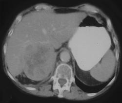 Adrenal Carcinoma - CTisus CT Scan
