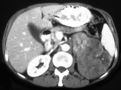 Adrenal Carcinoma - CTisus CT Scan
