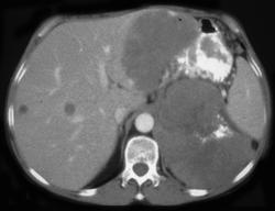 Adrenal Carcinoma With Lung Mets - CTisus CT Scan