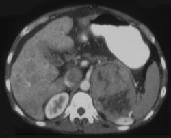 Adrenal Carcinoma - CTisus CT Scan