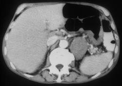 Adrenal Lymphoma-stomach and Spleen Also Involved - CTisus CT Scan