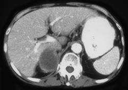 Adrenal Metastases-lung Cancer - CTisus CT Scan