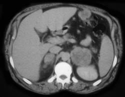 Adrenal Metastases-melanoma - CTisus CT Scan
