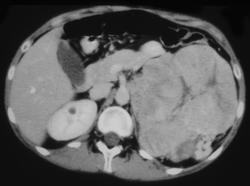 Adrenal Carcinoma - CTisus CT Scan