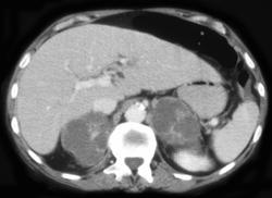 Adrenal Metastases - CTisus CT Scan