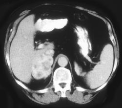 Pheochromocytoma - CTisus CT Scan