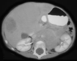 Adrenal Neuroblastoma - CTisus CT Scan
