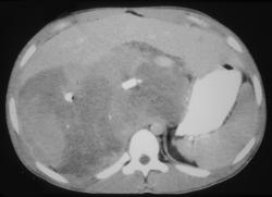 Ganglioneuroblastoma - CTisus CT Scan