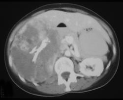 Adrenal Ganglioneuroblastoma - CTisus CT Scan