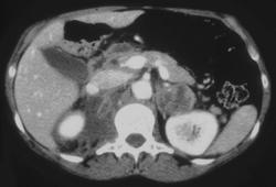 Adrenal Hemorrhage Due to Metastases From Lung Cancer - CTisus CT Scan