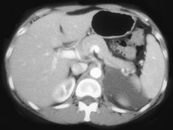 Adrenal Cyst - CTisus CT Scan