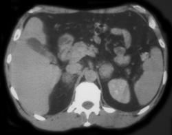 Adrenal Hematomas - CTisus CT Scan