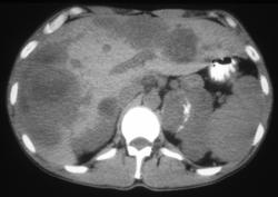 Malignant Pheochromocytoma - CTisus CT Scan
